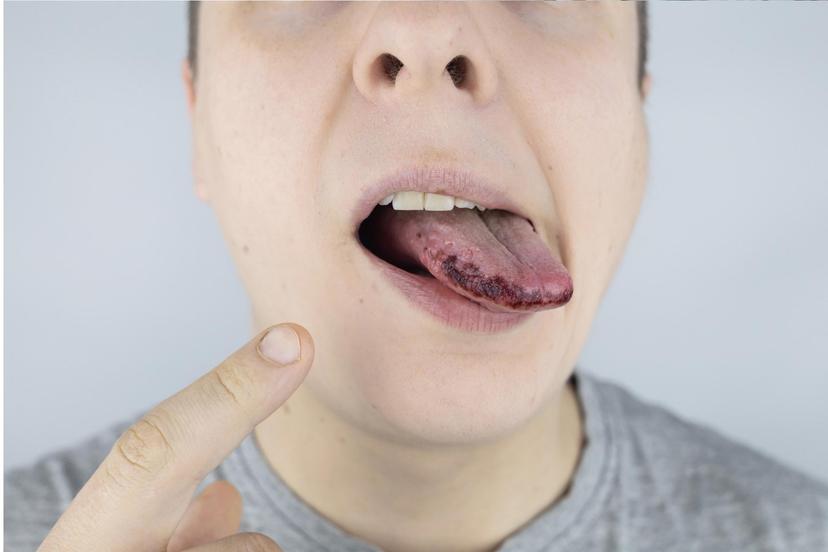 black-spots-on-the-tongue-symptoms-causes-and-treatment