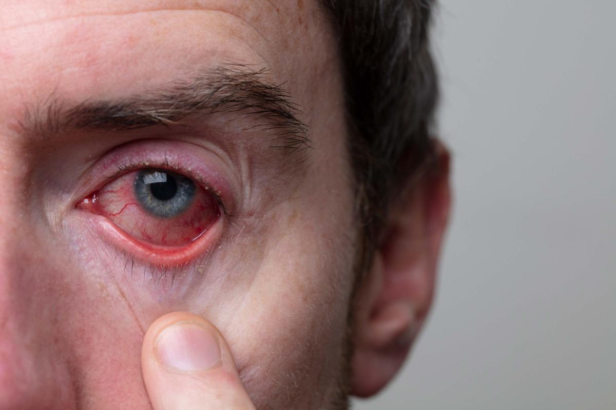 conjunctivitis-pink-eyes-causes-symptoms-and-treatment