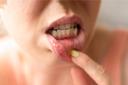 Oral Thrush: Causes, Symptoms, Prevention and Home Remedies