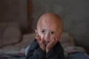 Progeria: Symptoms, Causes and Treatment