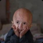 Progeria: Symptoms, Causes and Treatment