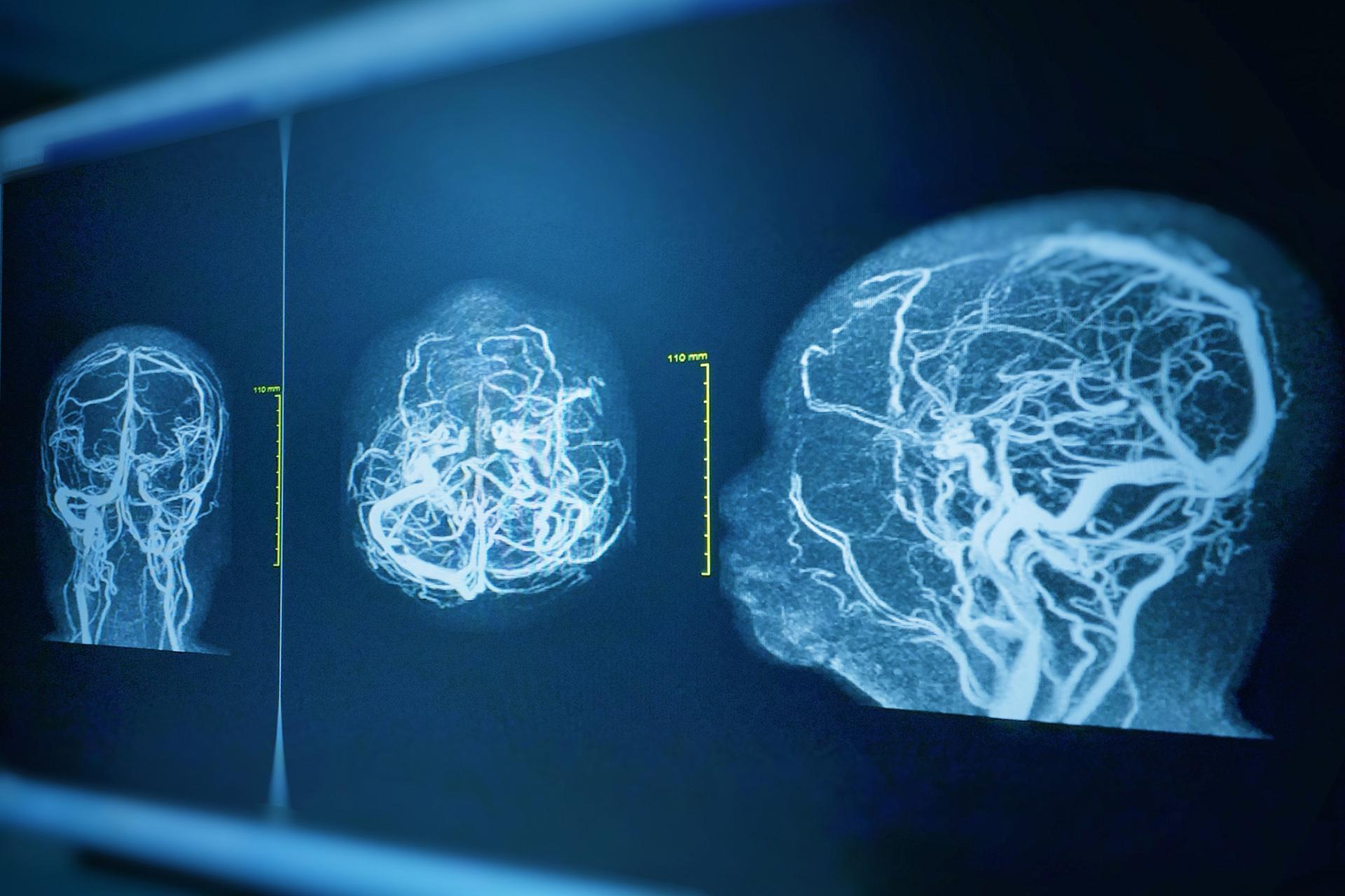 Difference Between a Stroke and a Brain Aneurysm