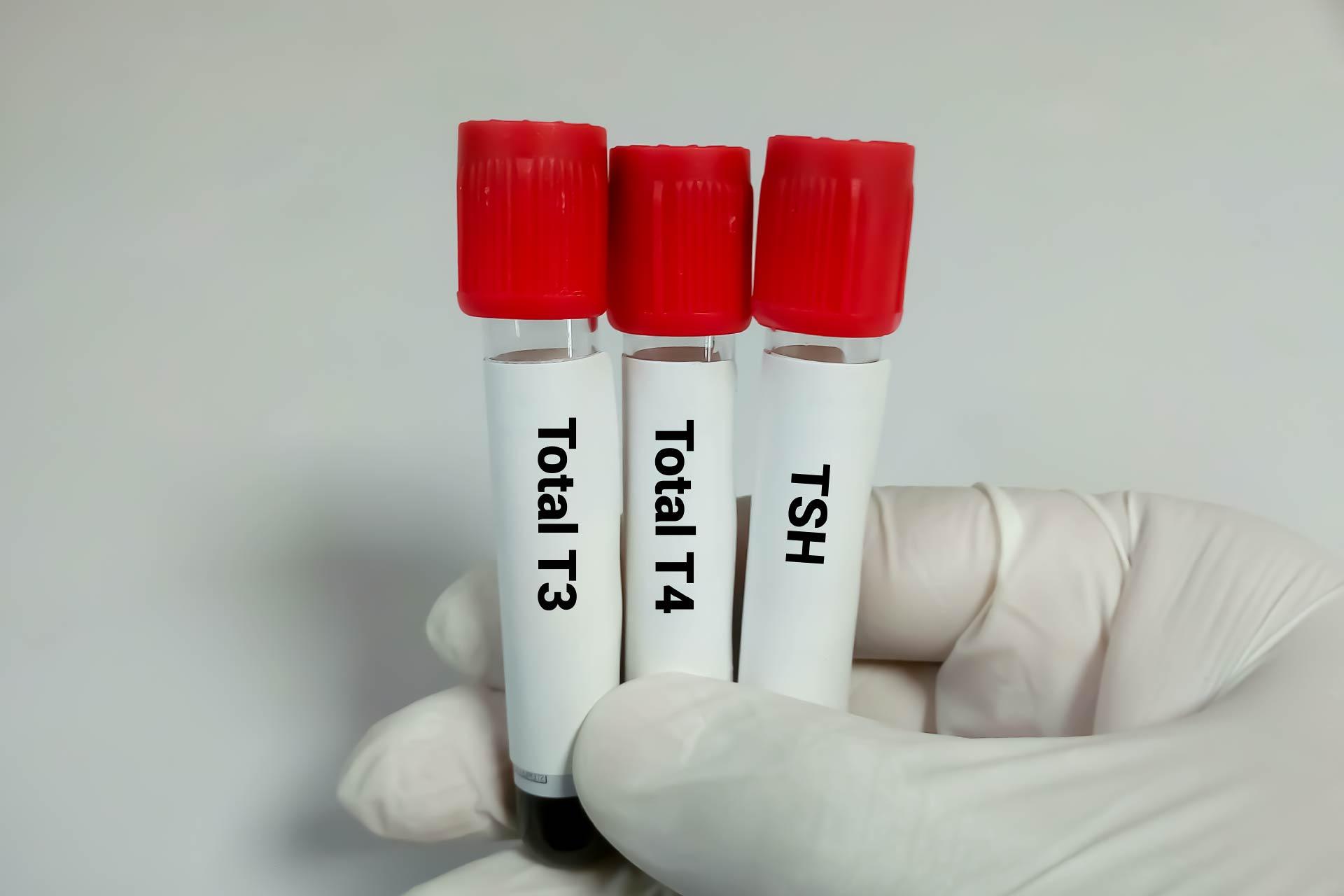 Triiodothyronine Test (T3 Test): Purpose, Procedure, Level and Limitation