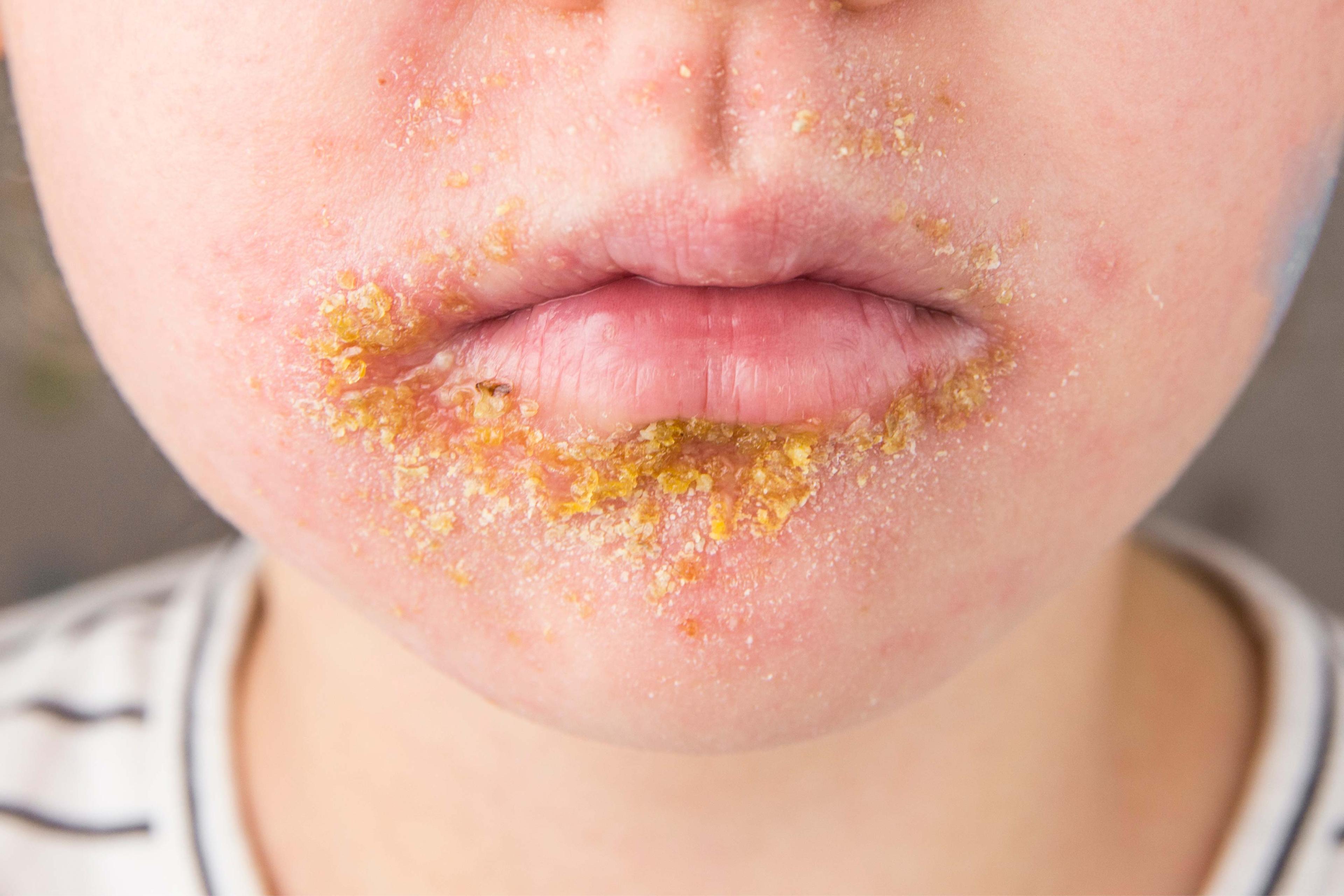 Impetigo: Symptoms, Causes, Contagious, Complications