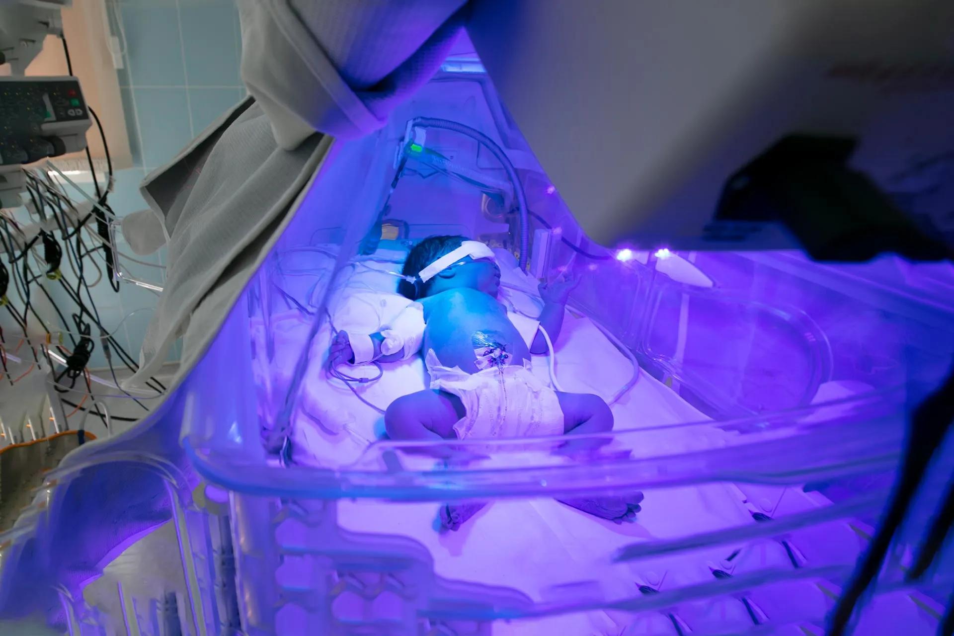 Newborn Jaundice: Causes, Prevention and Diagnosis