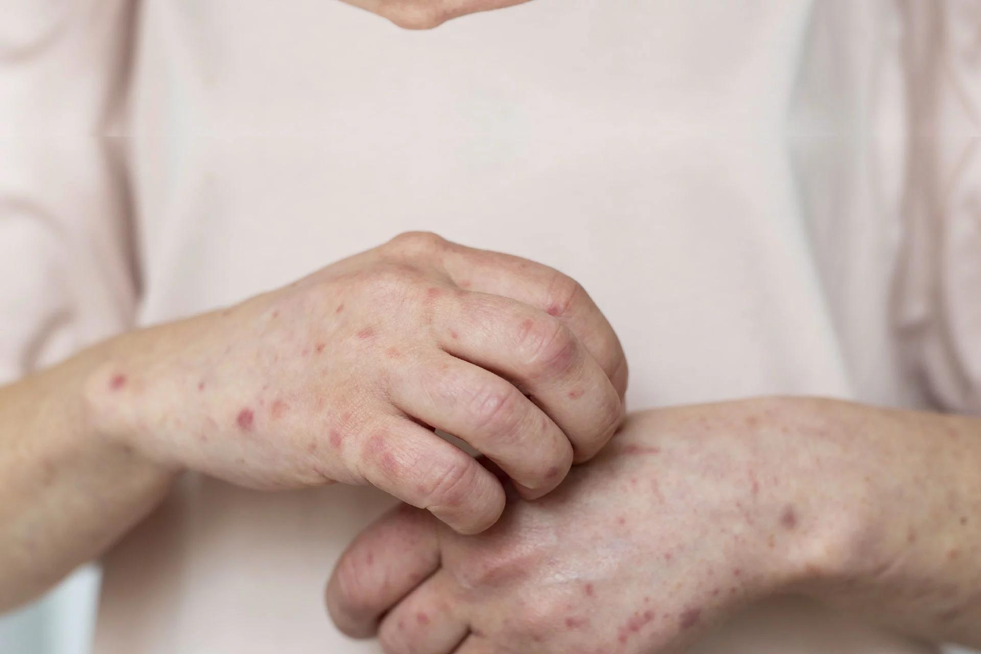 Seborrhoeic Dermatitis: 6 Salient Aspects of This Condition